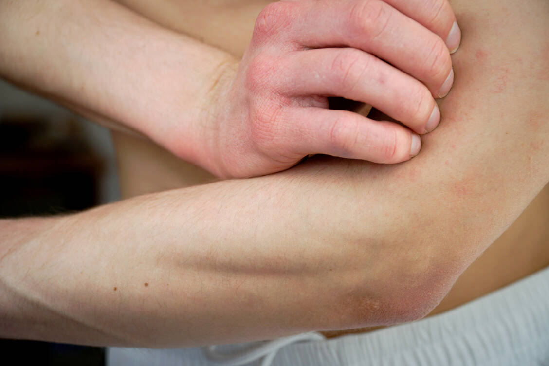 Bei der generalisierten pustulösen Psoriasis (GPP) können die Symptome bei jedem Schub unterschiedlich schwer ausfallen. / Foto: Adobe Stock/Georg