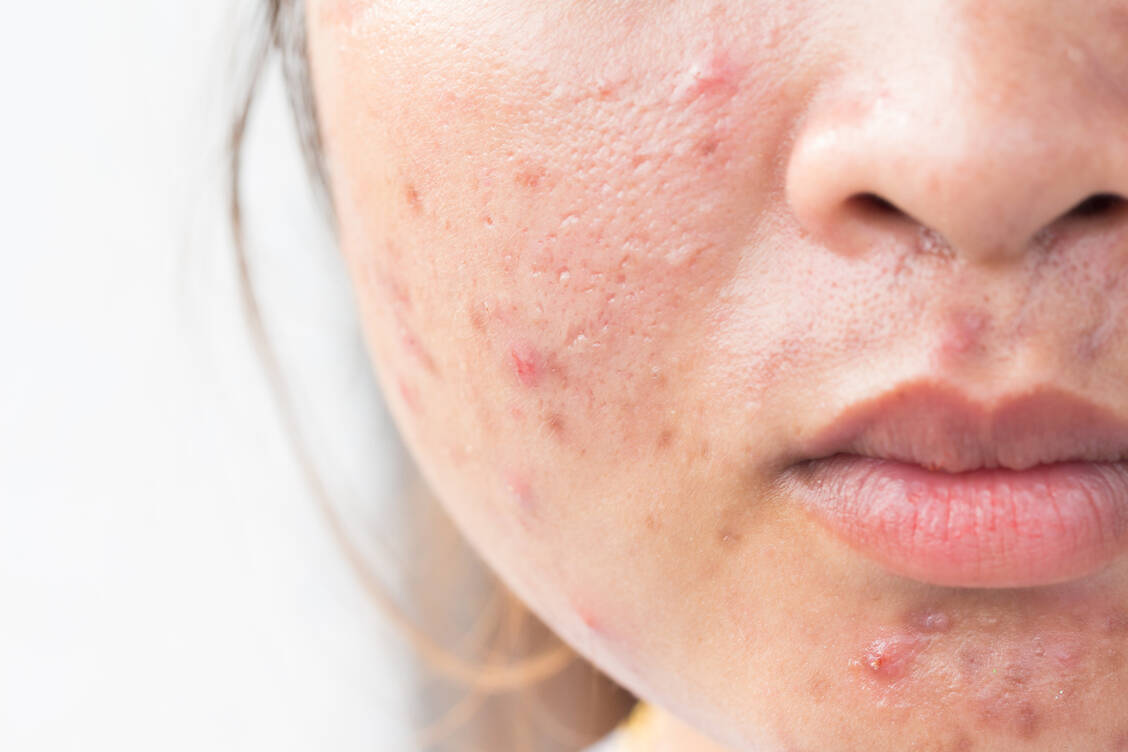 Akne ist ein mögliches Anzeichen der milderen Form des adrenogenitalen Syndroms. / Foto: Adobe Stock/frank29052515