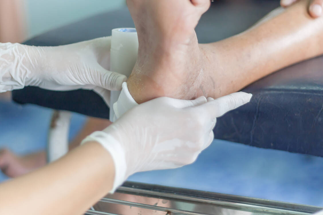 Schmerzfrei und gut verträglich – es klingt fast zu gut um, wahr zu sein, doch Kaltplasma scheint chronische Wunden, zum Beispiel infolge eines Diabetischen Fußsyndroms, tatsächlich ohne Nebenwirkungen schneller heilen zu lassen. / Foto: Adobe Stock/kirov1969