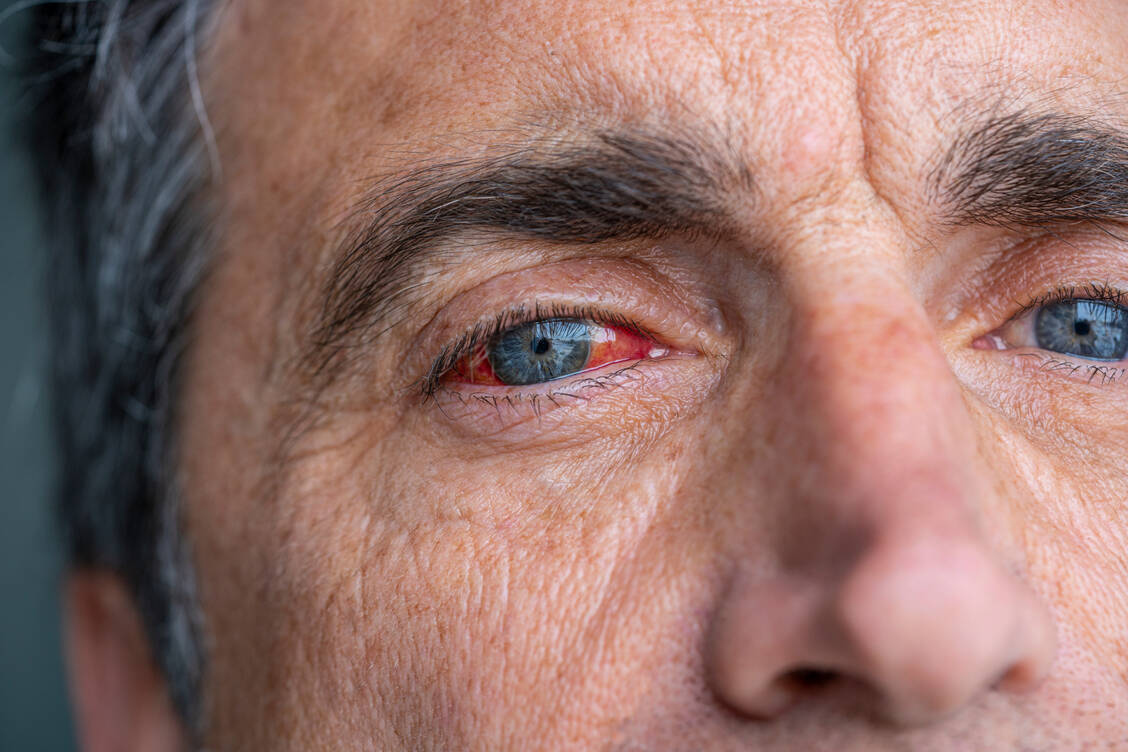 Ein rotes Auge kann vergleichsweise harmlose Ursachen haben. Aber bei bestimmten Begleitsymptomen sollten Betroffene schnell zum Arzt gehen.  / Foto: Getty Images/Mediterranean