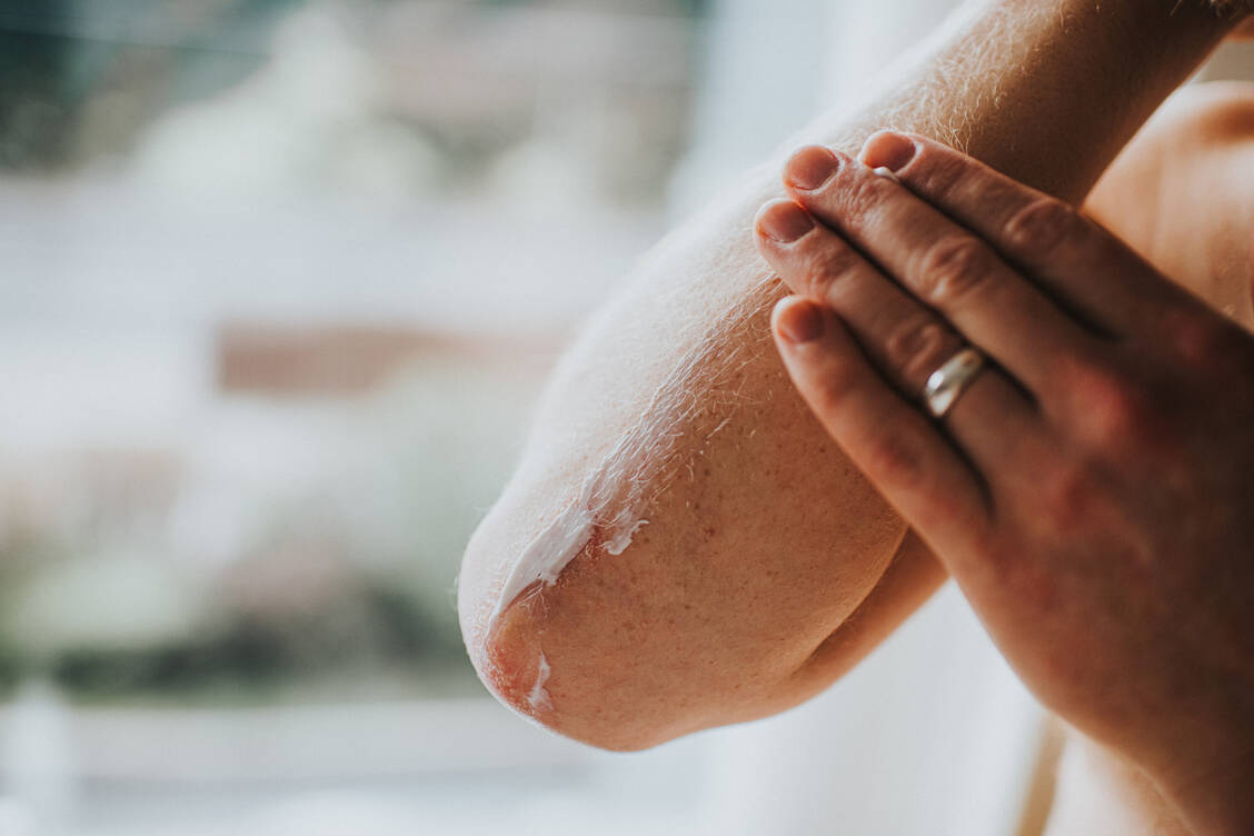 Zu den Basismaßnahmen gehört das zweimaltägliche Eincremen mit einer harnstoffhaltigen Creme. / Foto: Getty Images/Catherine Falls Commercial