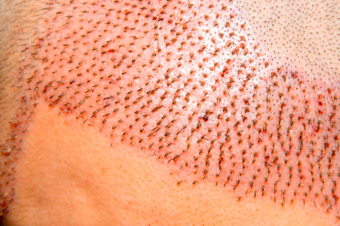 Haartransplantationen kosten etwa zwischen 2500 und 11.500 Euro.  / Foto: Adobe Stock/Sugrit