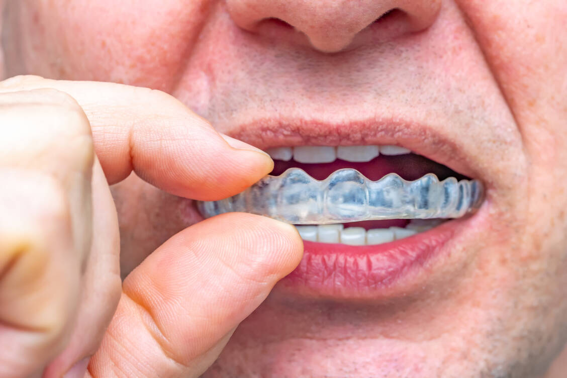 Neben Übungen zur Achtsamkeit helfen bei Bruxismus sogenannte Aufbissschienen / Foto: Adobe Stock/stylefoto24