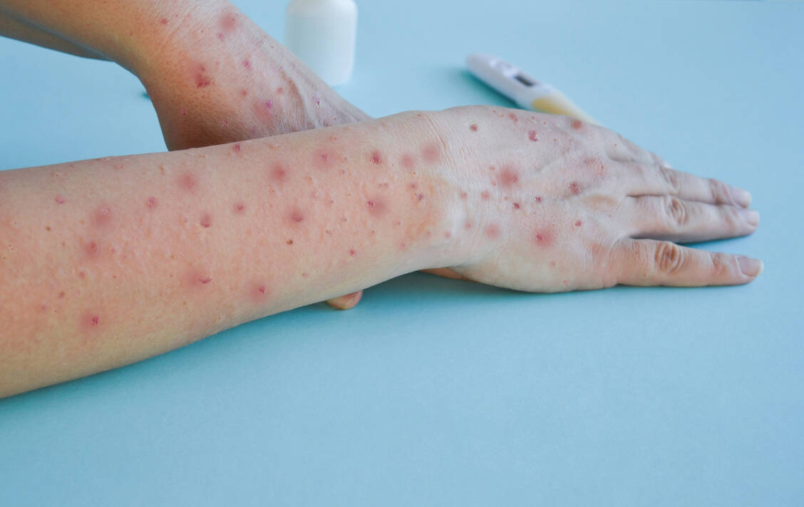Zu den Mpox-Symptomen zählen ein typischer Ausschlag sowie häufig auch allgemeine Krankheitssymptome. / © Adobe Stock/Ирина Старикова