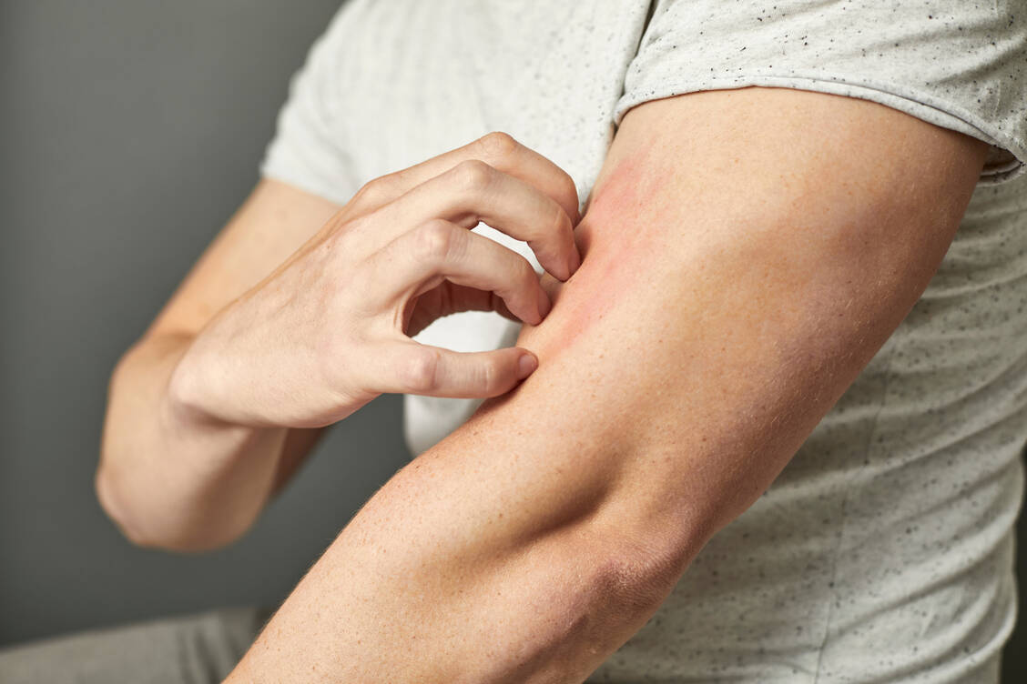 Im Winter reagiert die Haut meist empfindlicher und entwickelt schneller juckende oder gerötete Ausschläge. / © Adobe Stock/Maria Fuchs