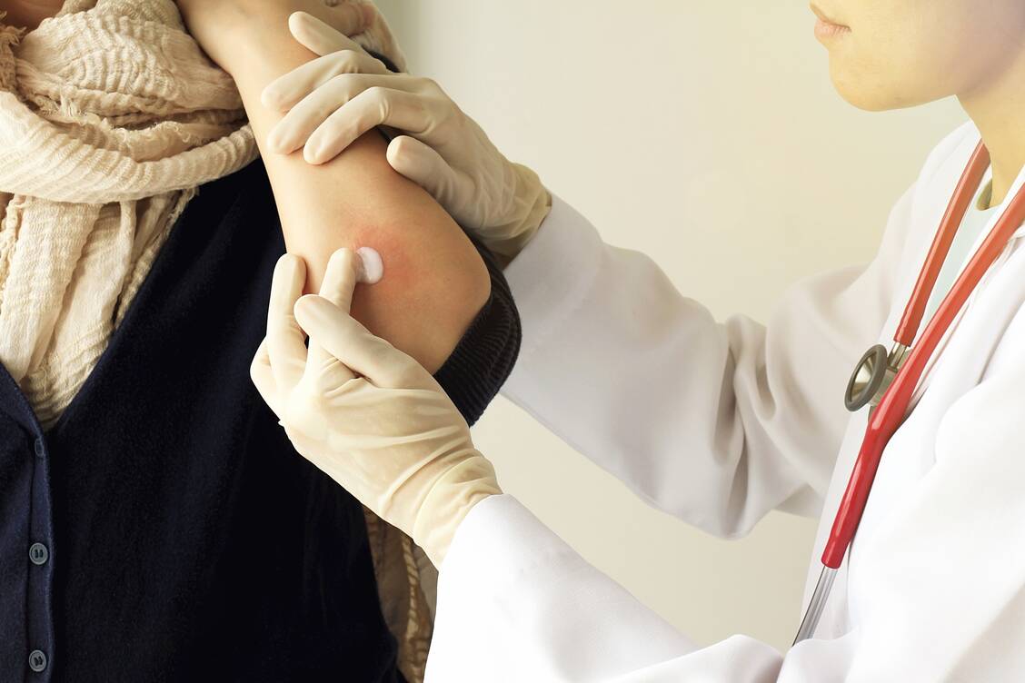 Die Fingertip Unit hilft beim richtigen Dosieren topischer Steroid-Zubereitungen. / Foto: Shutterstock/Artfully Photographer