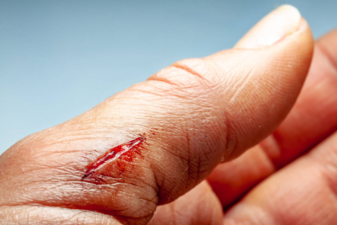 Der blaue oder rote Streifen am Arm als Hinweis auf eine Blutvergiftung ist übrigens eine Entzündung der Lymphbahnen und fehlt bei den allermeisten Blutvergiftungen, wie die Sepsis umgangssprachlich genannt wird. / © Adobe Stock / Lukassek
