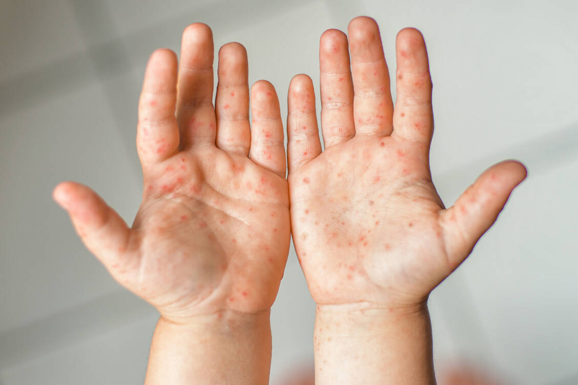 Der Ausschlag an Handinnenflächen und Fußsohlen kann stark jucken. Die Bläschen dürfen jedoch keinesfalls aufgekratzt werden. / Foto: Getty Images / Kipgodi
