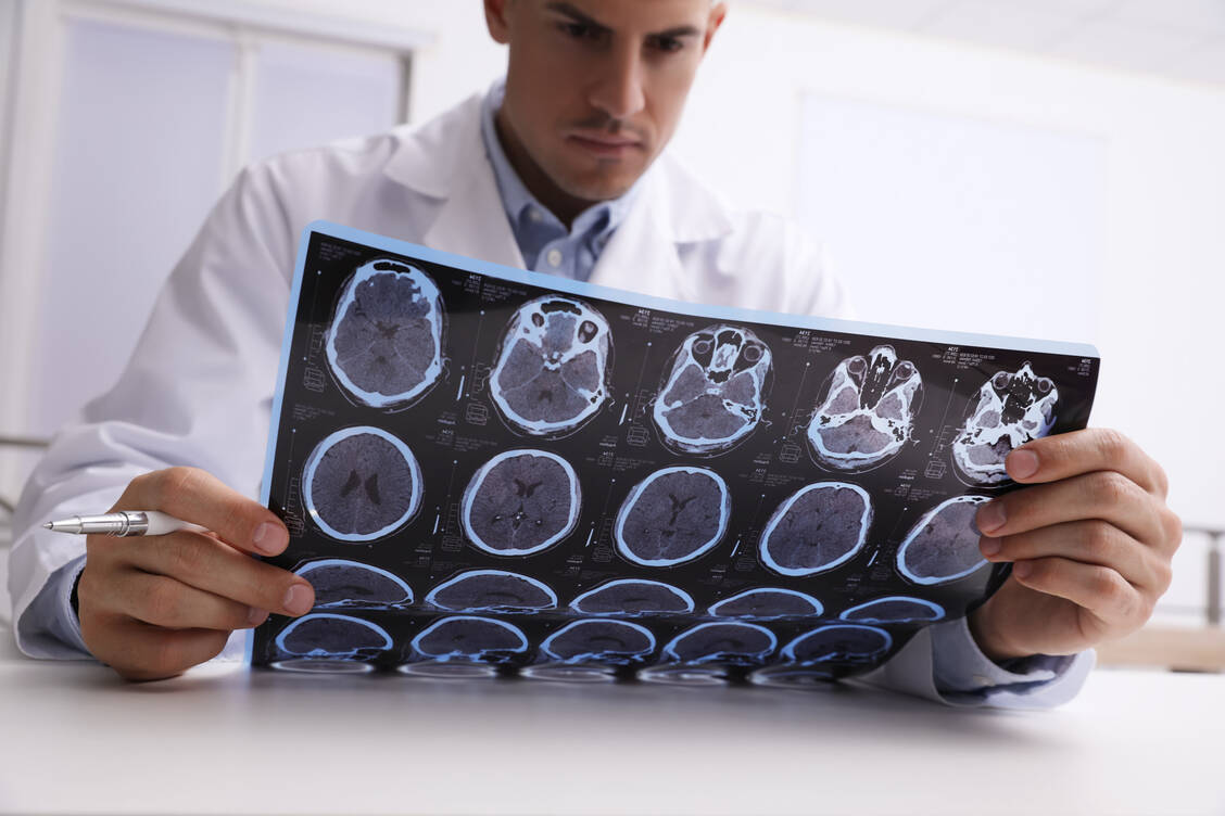 Unter der Antikörpertherapie können Nebenwirkungen im Gehirn auftreten. / © Adobe Stock/New Africa