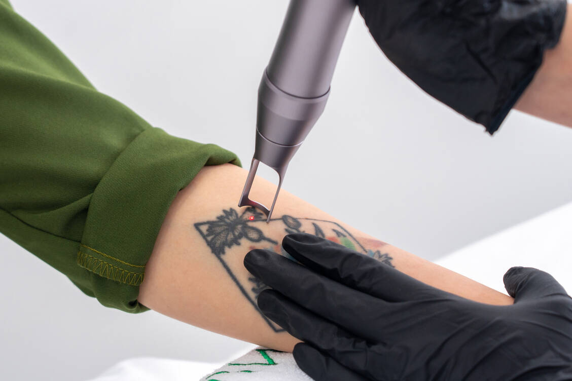 Wie gut sich ein Tattoo entfernen lässt, hängt von vielen Faktoren ab, wie zum Beispiel von der Stelle und der Größe des Tattoos. / © Getty Images/Mariakray