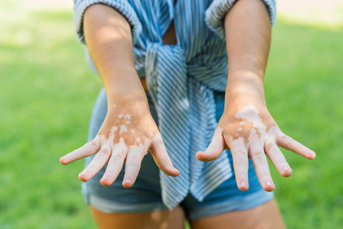 Vitiligo ist psychisch extrem belastend, auch wenn prominente Betroffene für mehr Offenheit sorgen. / Foto: Getty Images/Westend61