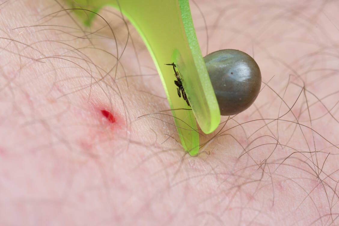 Weg mit der Zecke: Wer eine Zecke am Körper entdeckt, sollte sie so schnell wie möglich entfernen. Borrelien werden erst nach mehreren Stunden auf den Menschen übertragen, eine Infektion kann so wahrscheinlich verhindert werden. / © Adobe Stock/mirkograul