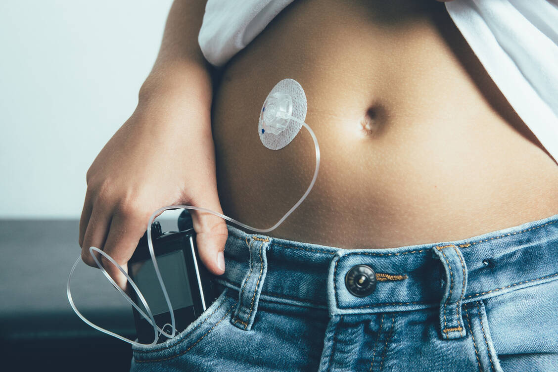 Kinder und Jugendliche mit Typ-1-Diabetes müssen regelmäßig Insulin substituieren.  Eine Insulinpumpe kann das tägliche Spritzen ersetzen. / Foto: Adobe Stock/click_and_photo