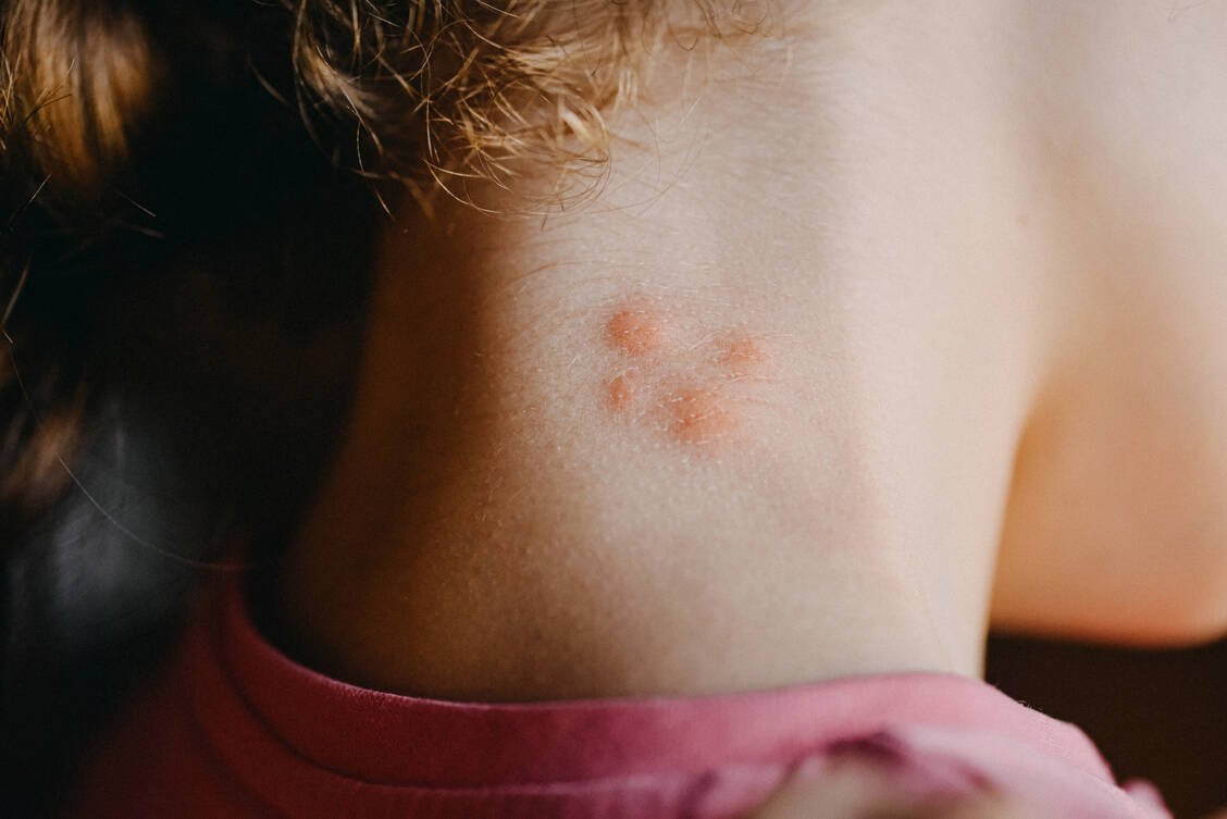 Mückenstiche können schmerzhaft sein und jucken. Eine leichte Schwellung ist normal. / Foto: Getty Images/Stefania Pelfini, La Waziya Photography