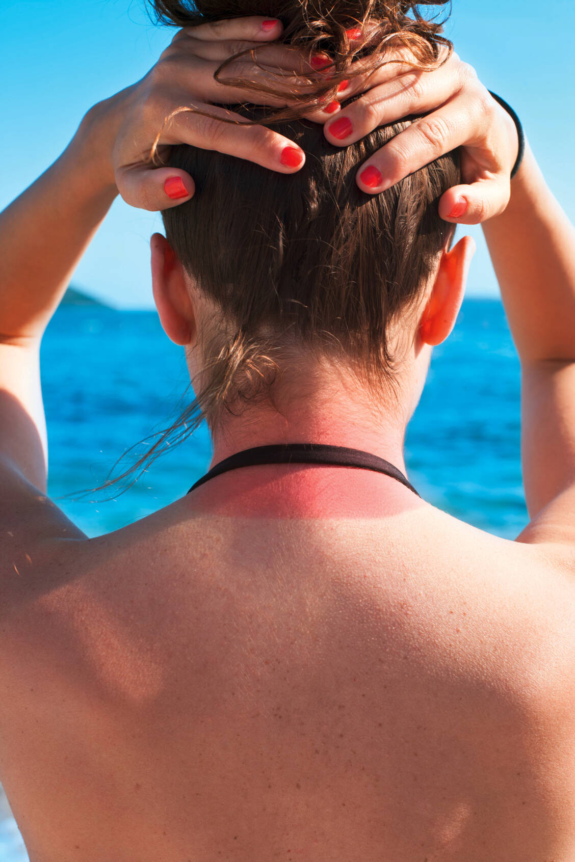 Ein Sonnenbrand (Dermatitis solaris) ist eine akute Entzündung der Haut durch zu viel UV-Strahlung. Hellhäutige Menschen sind besonders anfällig. / Foto: Shutterstock/Marco Marcello