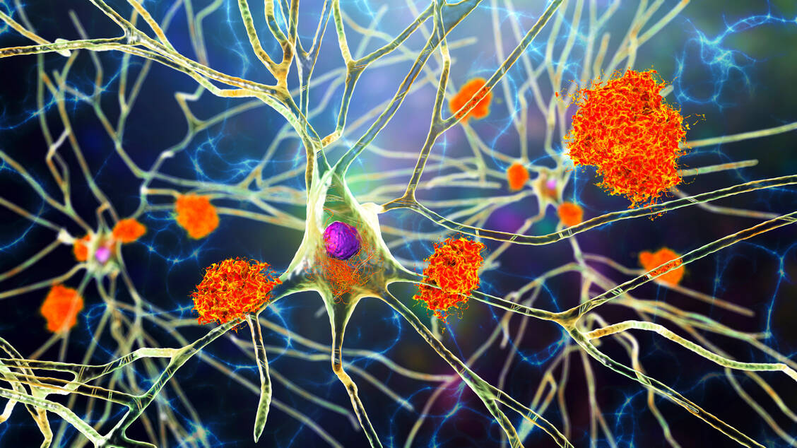 Ablagerungen von Amyloid-Plaques und Tau-Fibrillen im Gehirn sind ein charakteristisches Merkmal der Alzheimer-Erkrankung. Sie beeinträchtigen die Kommunikation zwischen den Zellen und führen nach und nach zum Absterben von Nervenzellen. / © Getty Images/Kateryna Kon/Science Photo Library