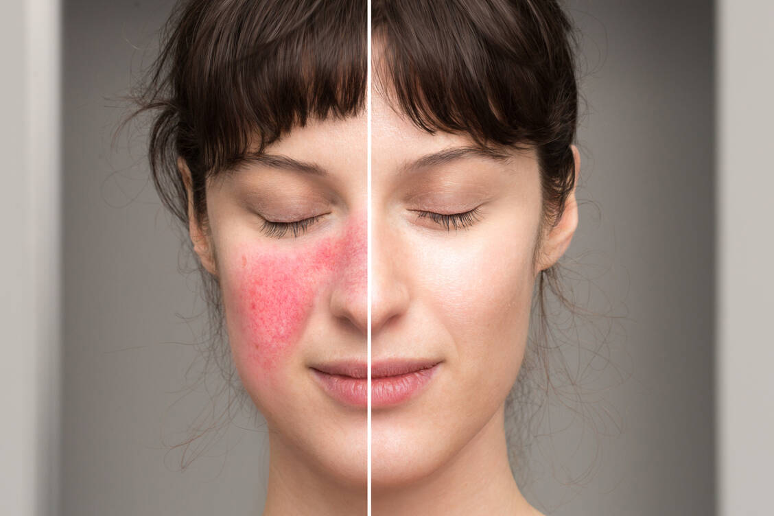 Erstes Symptom einer Lupus-Erkrankung ist häufig eine fleckige Rötung auf Nasenrücken und Wangen. / Foto: Adobe Stock/Alessandro Grandini