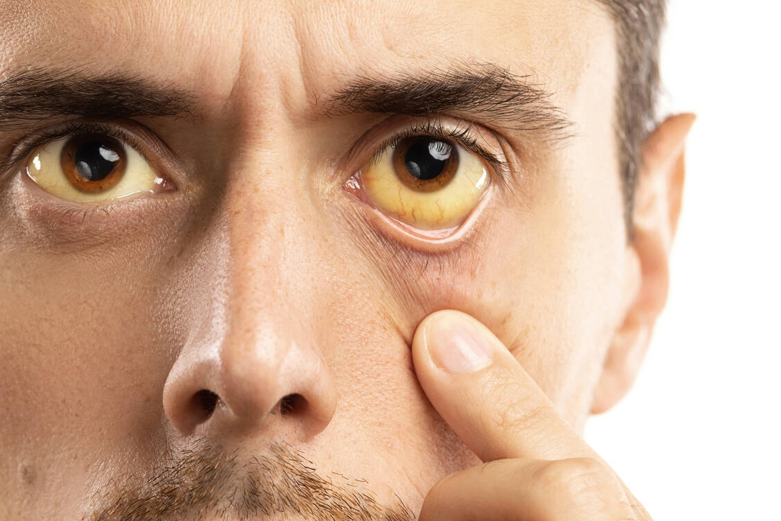 Gelbe Augen: Bei einer Leberschädigung kann der Gallenfarbstoff Bilirubin eine Verfärbung des Augenweiß hervorrufen. / Foto: Adobe Stock/blackday