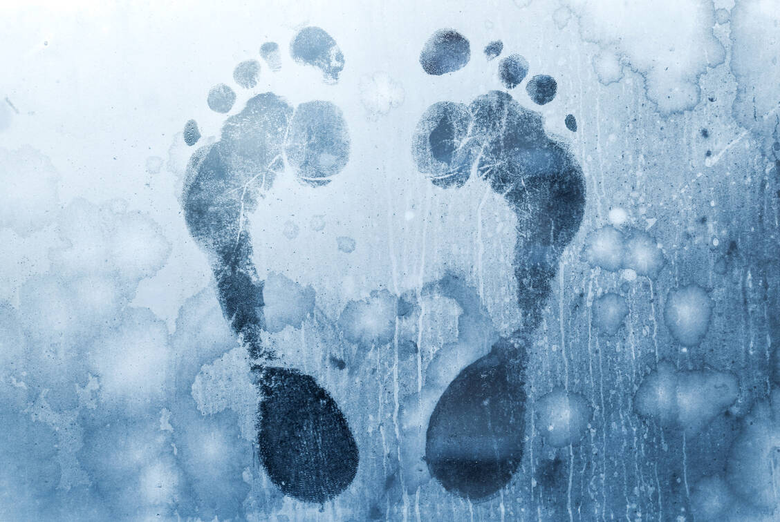 Warzen beispielsweise an den Füßen können durch Vereisung effektiv bekämpft werden. Dabei lassen sich an der Warze  durch Verwendung von Diemethylether-Propan-Gemischen Temperaturen zwischen -50° und -60° Celsius erreichen. / Foto: Getty Images/eugenesergeev