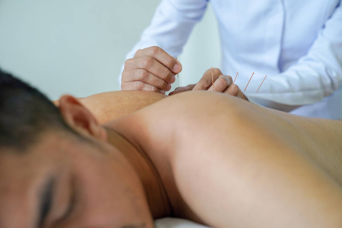 Lange Nadeln werden beim »Dry Needling« in Triggerpunkte gesetzt, um Verspannungen zu lösen. / Foto: Adobe Stock/PordeeStudio