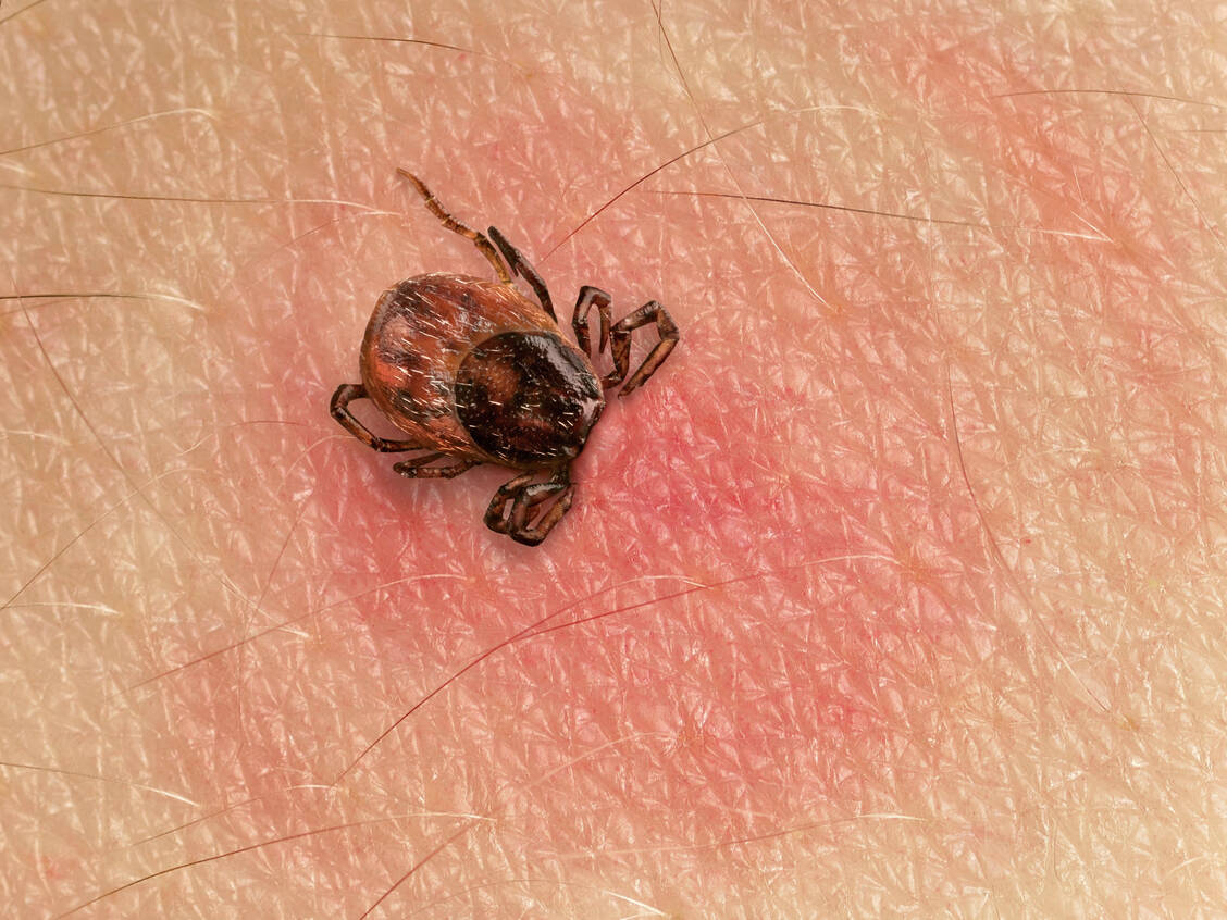 Entwickelt sich auf der Hut ein Erythema migrans, bedarf es dringend einer Therapie. / Foto: Shutterstock