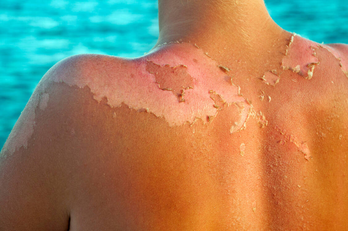 Die Haut heilt nach einem Sonnenbrand mit der Zeit wieder, die Zellschäden, die auf das Hautkrebsrisiko einzahlen, lassen sich dagegen nicht ungeschehen machen. / © Getty Images/Kadir Barcin