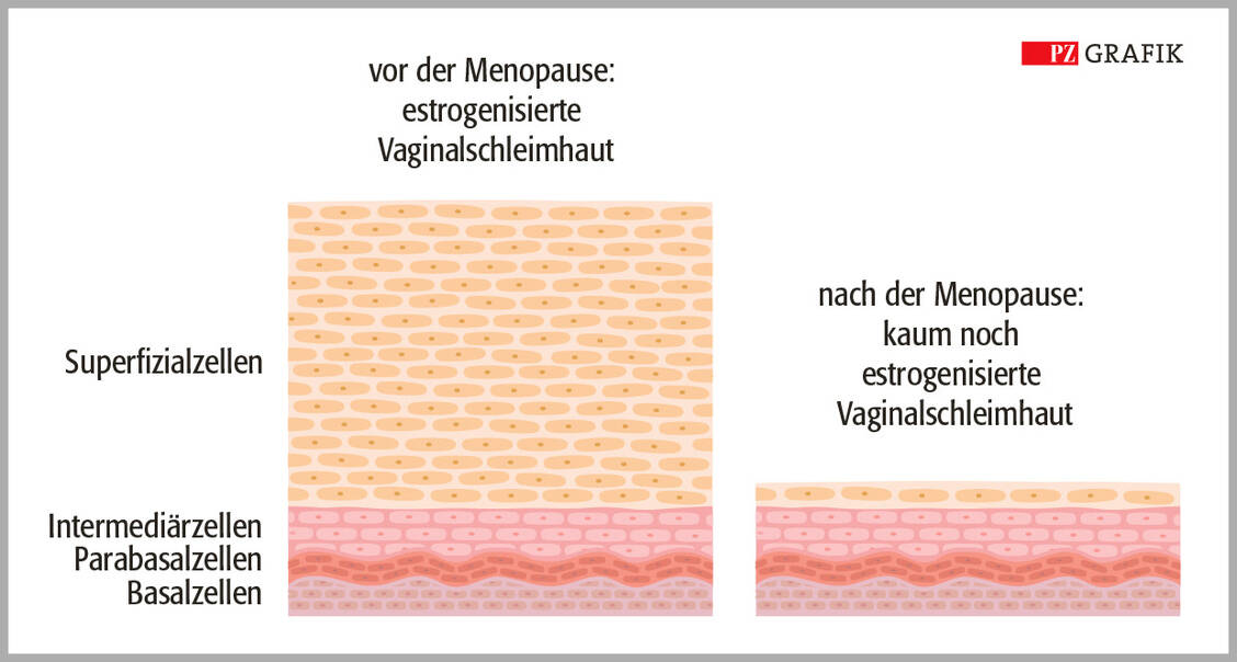Der Unterschied ist deutlich: Das nicht verhornte Plattenepithel der Vaginalschleimhaut ist vor der Menopause mit einer üppig präsenten Schicht von Superfizialzellen ausgestattet. Sinken die Estrogenspiegel, schwinden die Superfizialzellen, was die Vaginalschleimhaut pergamentartig und entzündungsanfällig werden lässt. / © PZ-Grafik/Jens Ripperger