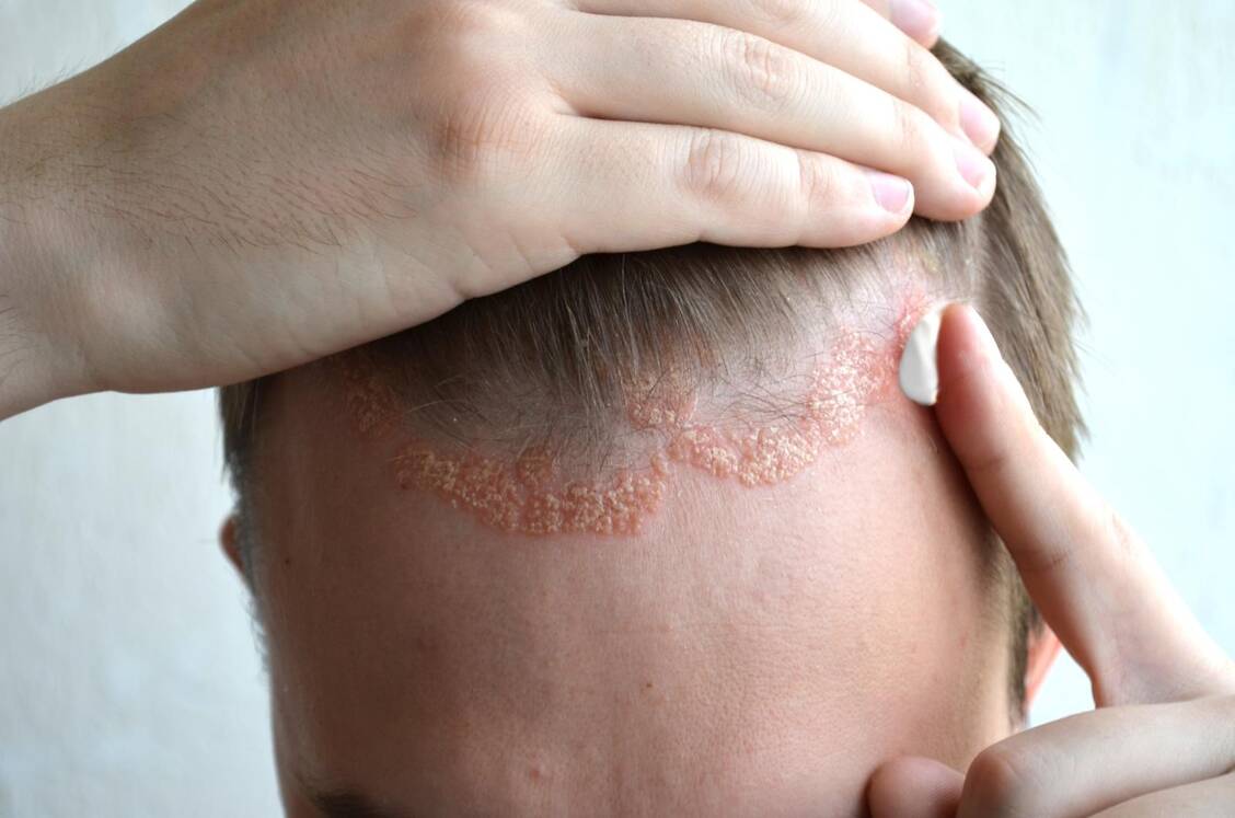 Dithranol hemmt das Zellwachstum und wird meist verwendet, um Psoriasis lokal zu behandeln. Foto: Adobe Stock/VIlia