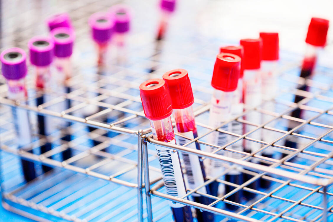 Bei Prostatakrebs tritt PSA vermehrt ins Blut über, was in Blutproben untersucht werden kann. / Foto: Getty Images/Srinophan69