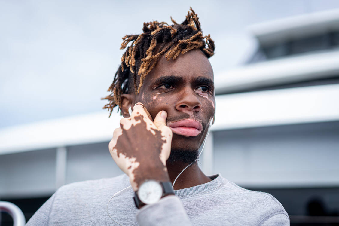 Vitiligo-Patienten fehlt es stellenweise an dem Hautpigment Melanin. Weiße Flecken zeigen sich dann vor allem im Gesicht sowie an Händen und Füßen. / Foto: Getty Images/Jasmin Merdan