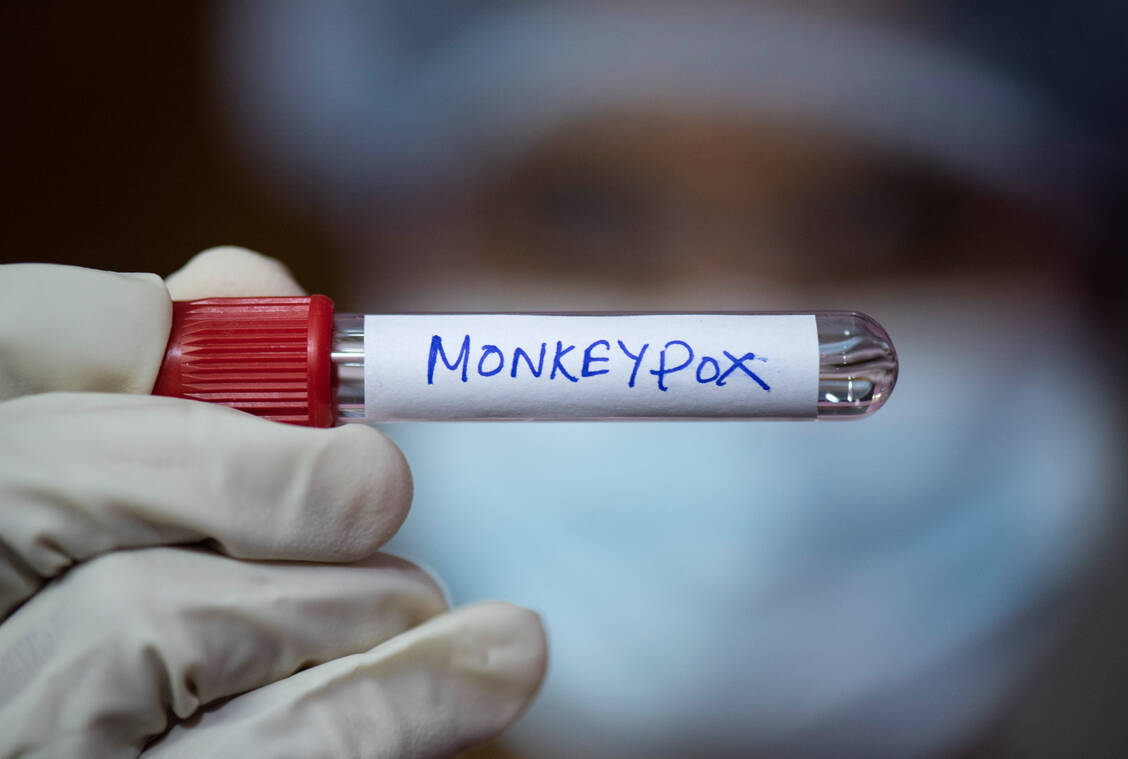 In Afrika verbreitet sich das Mpox-Virus rasant. Dort wurden vor einigen Tagen mehr als 2700 neue Fälle in einer Woche registriert. / © Getty Images/David Talukdar