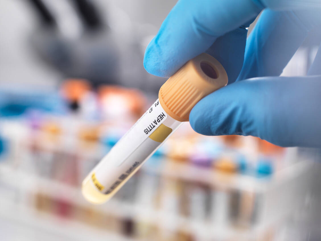 Die Symptome einer Hepatitis sind häufig unspezifisch. Im Blut sind die Hepatitis-Viren nachweisbar.  / Foto: Getty Images/Westend61
