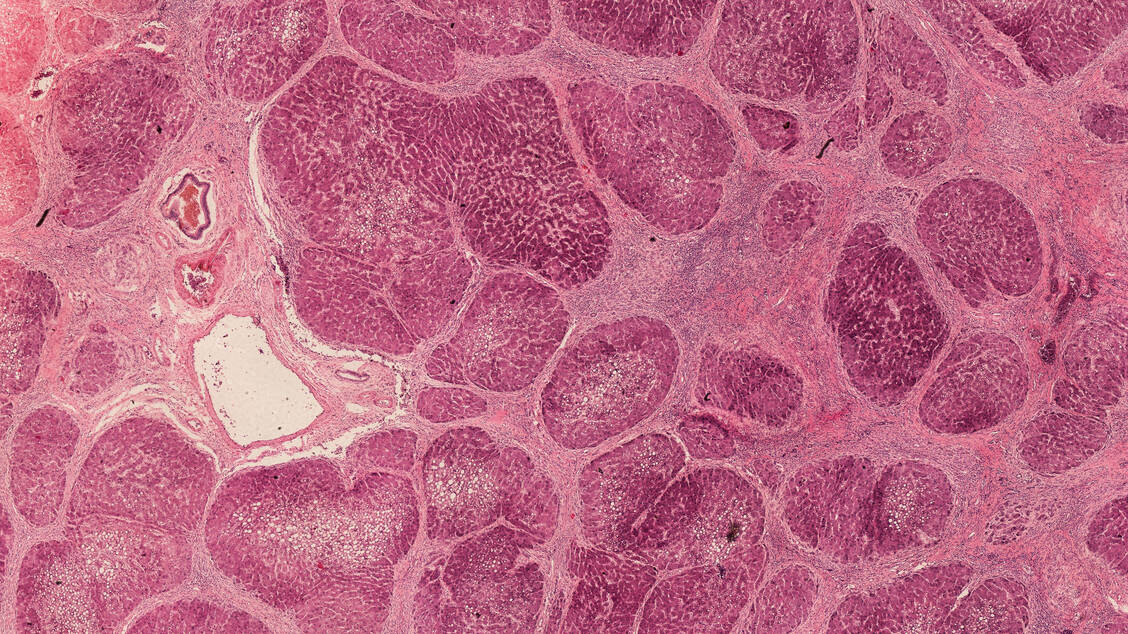 In 10 bis 15 Prozent aller Fälle sind zum Zeitpunkt der NASH-Diagnose bereits Anzeichen einer Leberzirrhose vorhanden. / Foto: Adobe Stock/klickit24
