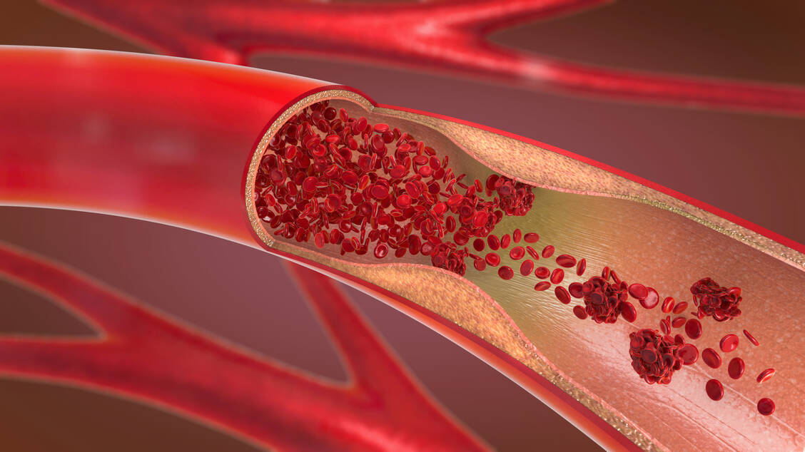 Mittlerweile weiß man: Covid-19 kann auch die Gefäße schädigen. Engmaschige Kontrollen etwa von Thrombose-Risikopatienten sind deshalb angezeigt. / Foto: Adobe Stock/Christoph Burgstedt