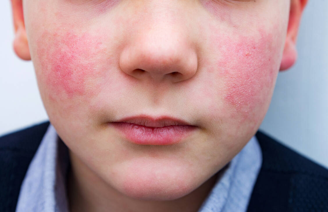 Ein feuerrotes Exanthem auf den Wangen ist typisch für eine Ringelröteln-Infektion. / Foto: Adobe Stock/Evgen