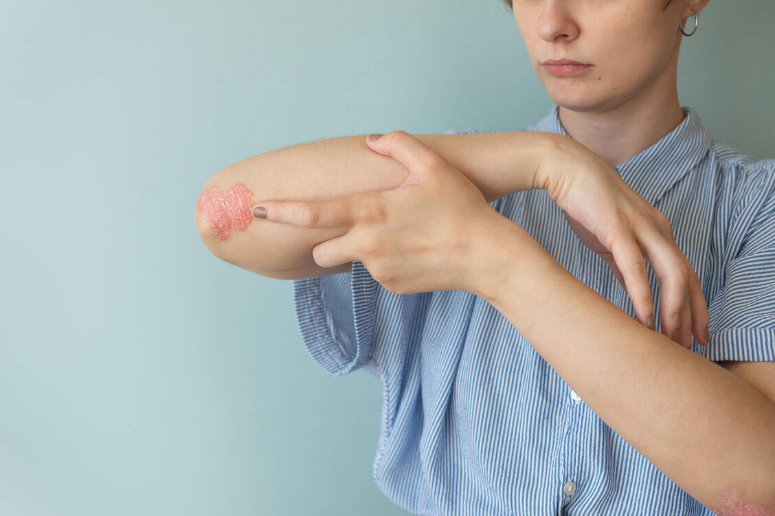 Psoriasis betrifft oft die Haut am Ellenbogen; doch die Krankheit kann auch das Gelenk selbst angreifen. / © Adobe Stock/Maria