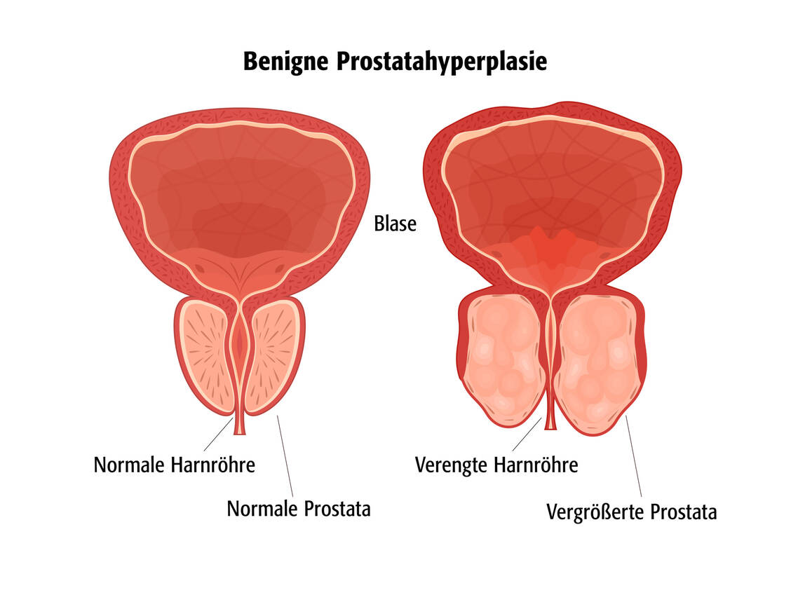 Die Prostata liegt unterhalb der Harnblase und umgibt die Harnröhre. Wenn das Drüsengewebe wächst, engt es die Harnröhre ein und kann die Blasenfunktion beeinträchtigen. / © Getty Images/Bigmouse108