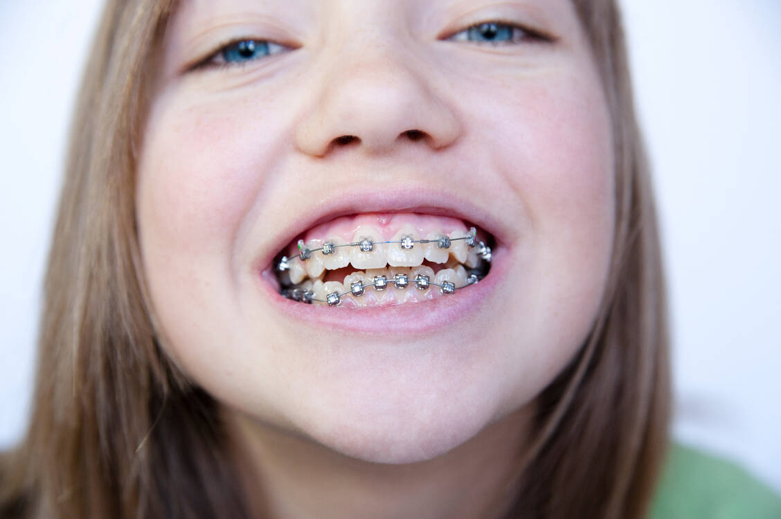 Wer Zähne zeigen will, muss pflegen. Brackets-Träger sollten etwa Interdentalbürstchen immer dabei haben.  / Foto: Getty Images/martinedoucet