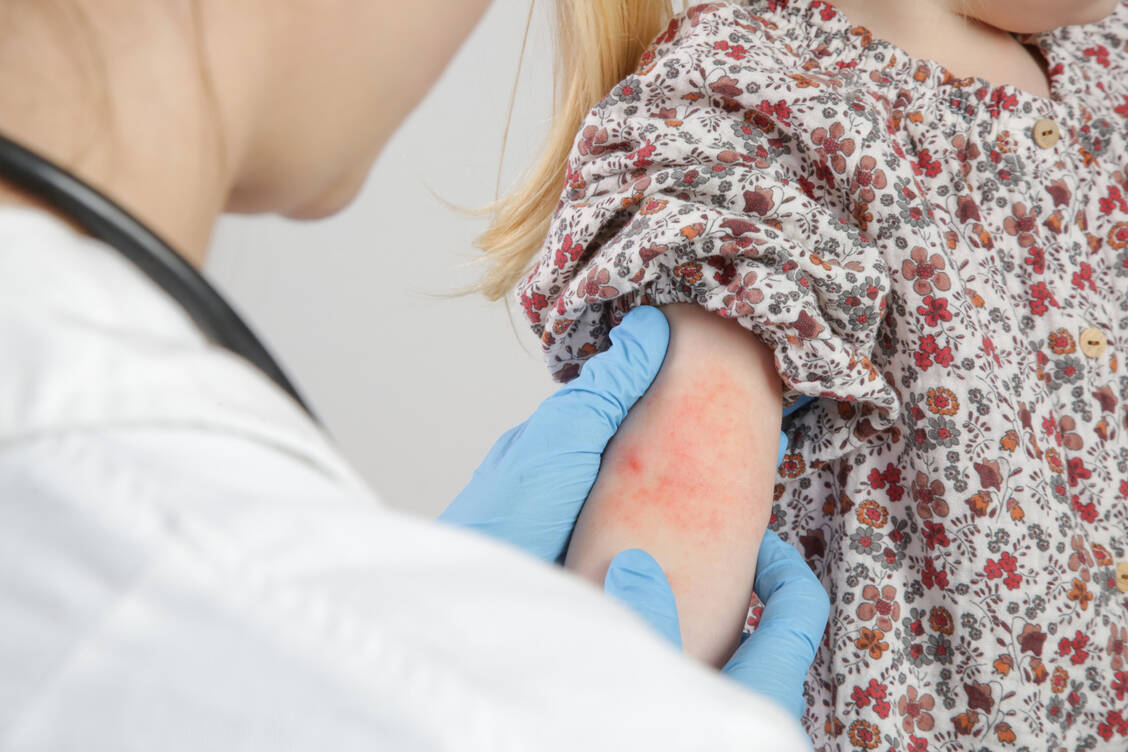 Von einer atopischen Dermatitis mit Trockenheit, roten Flecken, Bläschen und Schuppung der Haut sind in Deutschland etwa 3,5 Millionen Menschen betroffen – vor allem Kinder. / Foto: Getty Images/triocean