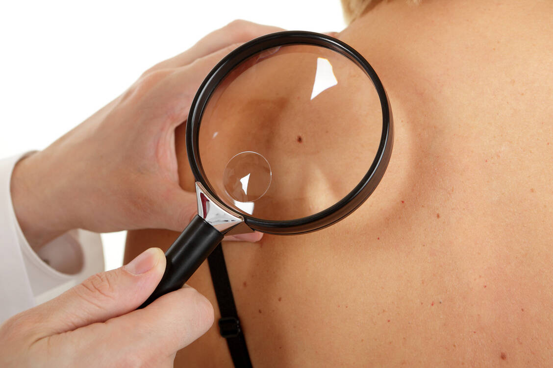 Heute ergänzen moderne Diagnoseverfahren klassische Methoden der Hautkrebs-Vorsorge. / Foto: ©fovito - stock.adobe.com