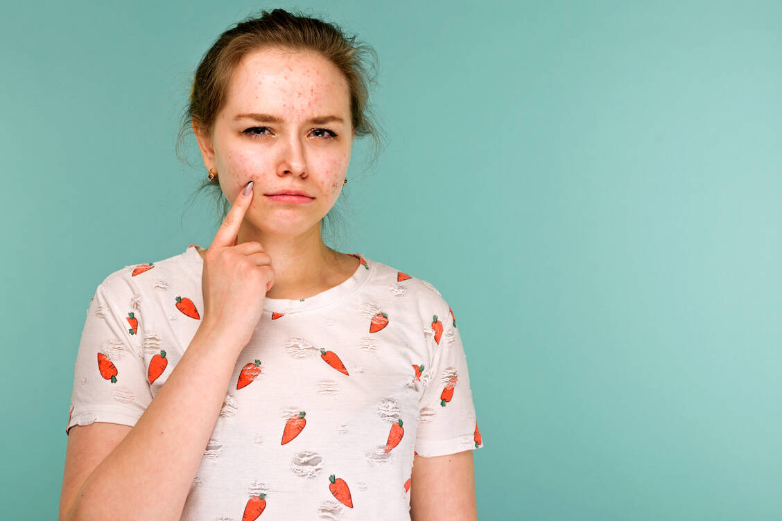 Der Wirkstoff Isotretinoin kommt bei Formen schwerer Akne zum Einsatz. Bei Frauen im gebärfähigen Alter ist jedoch Vorsicht geboten.  / Foto: Adobe Stock/filins