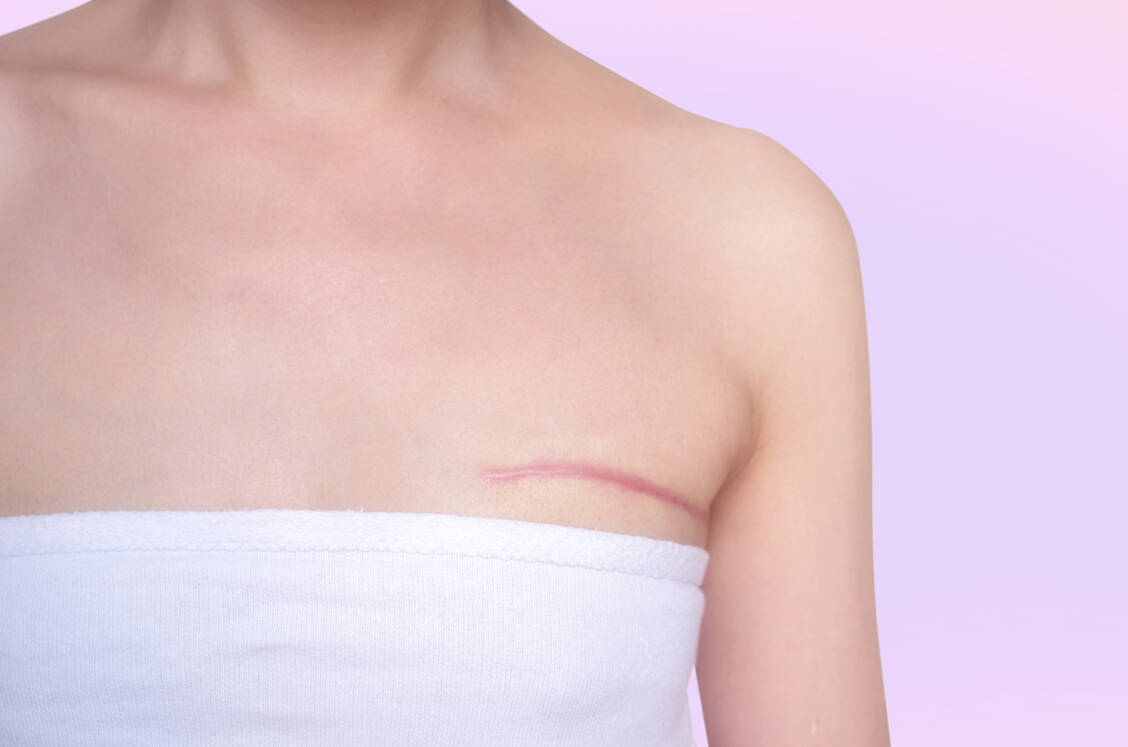 Gute Pflege mit speziellen Wirkstoffen trägt zu einer unauffälligen Narbenbildung bei. / © Adobe Stock/Pradit