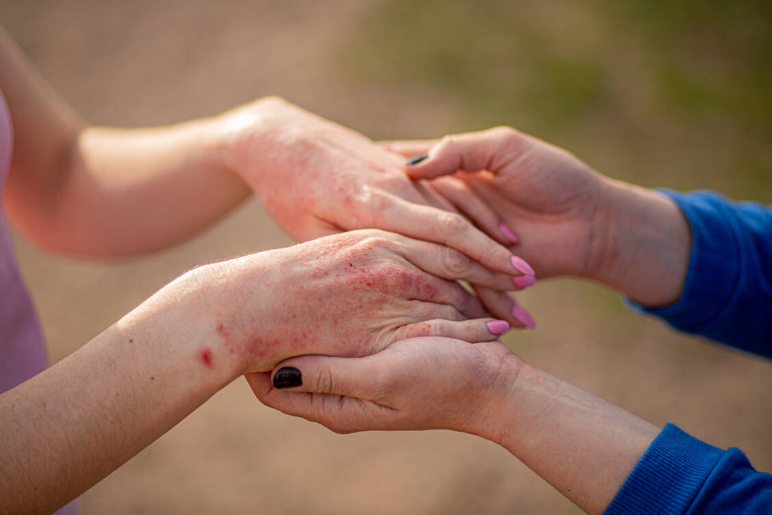 Einmal allergisch, immer allergisch: Bei einer Kontaktallergie hilft nur konsequentes Meiden des Auslösers. Bei Benzylalkohol ist das gar nicht so einfach.  / © Getty Images/Irina Esau