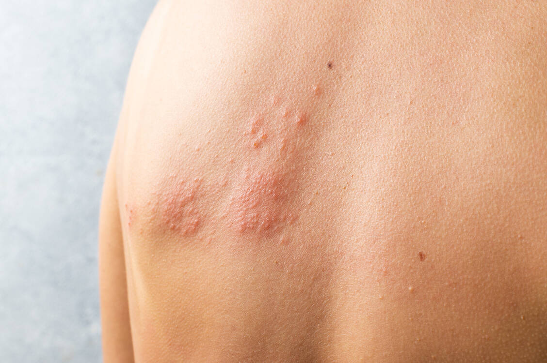 Kann die Covid-19-Impfung die Reaktivierung des Varizella-Zoster-Virus und damit eine Gürtelrose auslösen? Die Datenlage spricht gegen einen kausalen Zusammenhang. / Foto: Adobe Stock/sashka1313