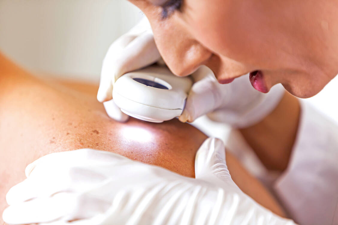 Das Plattenepithelkarzinom zählt zu den am häufigsten diagnostizierten Hauttumoren. / Foto: iStock/kali9