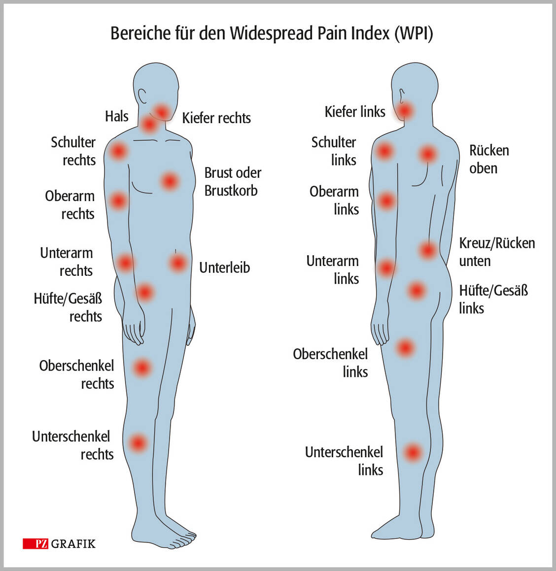 Der Widespread Pain Index (WPI) ist ein Teil der FMS-Diagnosefindung. Um ihn zu bestimmen, gibt der Patient an, in wie vielen der 19 ausgewiesenen Körperstellen er in der letzten Woche Schmerzen hatte. Der Wert kann zwischen 0 und 19 liegen. / © PZ-Grafik/Jens Ripperger, Adobe Stock/hiro
