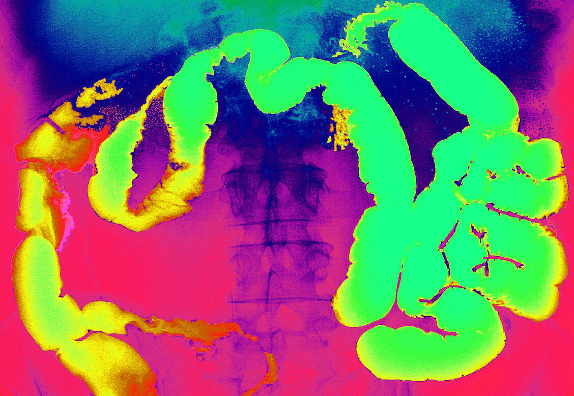 Problemfall Darm: Bei der Colitis ulcerosa betreffen die Entzündungen »nur« das Colon, bei Morbus Crohn können sie sich über den gesamten Gastrointestinaltrakt ausdehnen. / Foto: Your Photo Today