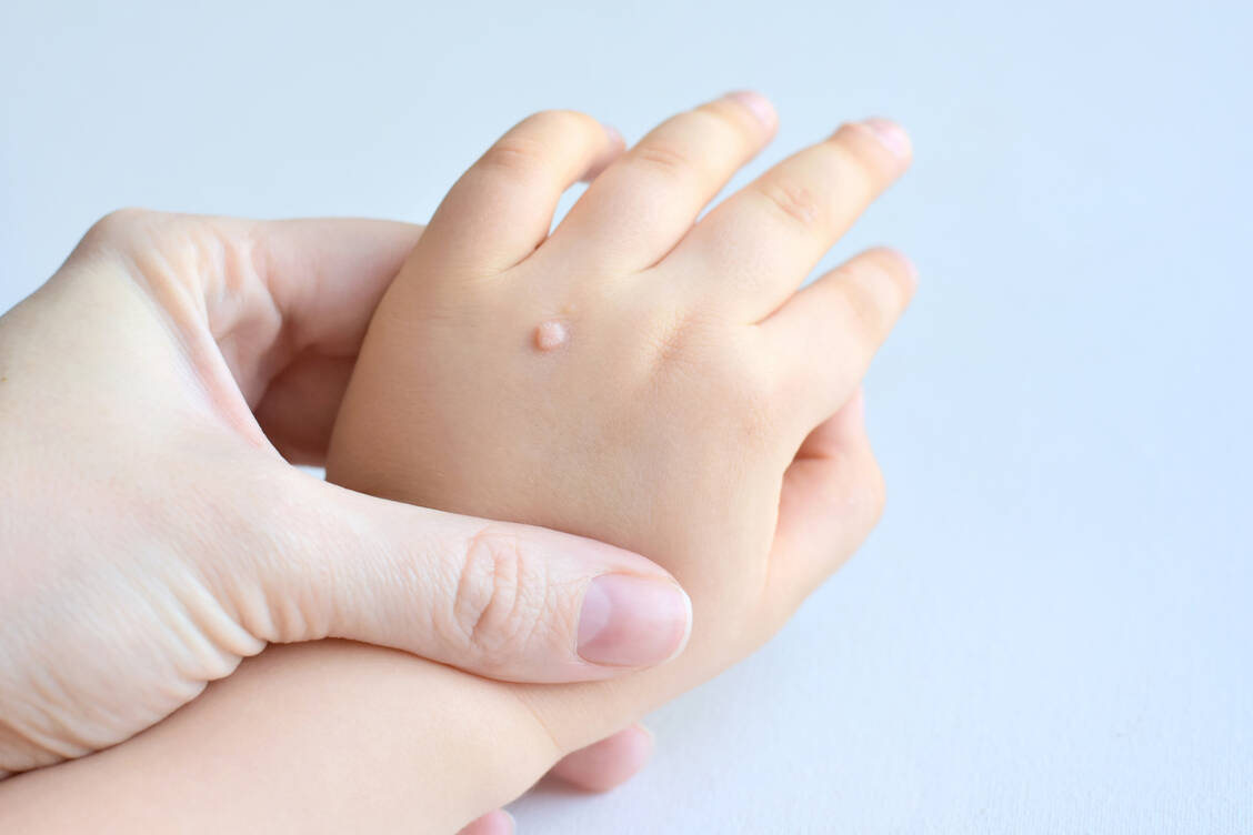 Bei Kindern sind Warzen keine Seltenheit. Daran knibbeln sollten sie nicht, damit sich die Viren nicht ausbreiten. / Foto: Adobe Stock/Tanya Ivanova