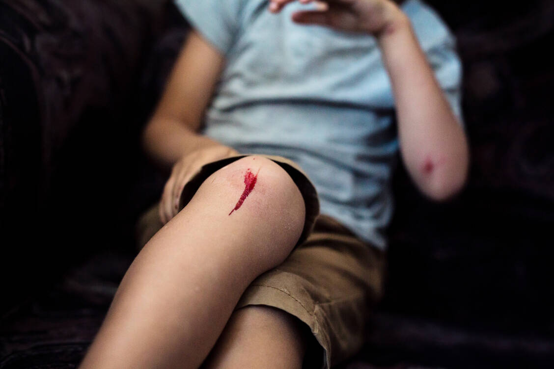 Auch wenn es Risikogruppen für das Auftreten einer Sepsis gibt: Eine Sepsis kann jeden treffen – durch teils banale Ursachen wie ein aufgeschürftes Knie. Es ist deshalb immer wichtig, einer Infektion durch eine gute Wundversorgung vorzubeugen. / Foto: Getty Images/Martins Rudzitis