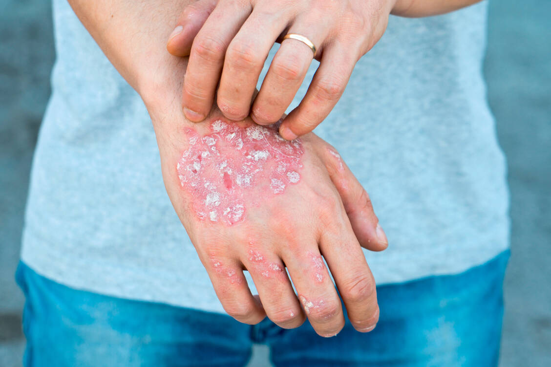 Eine Psoriasis-Erkrankung kann Betroffene sehr belasten. Mit der richtigen Arzneimitteltherapie und einer adäquaten Hautpflege kann die Schuppenflechte aber meist gut kontrolliert werden. / Foto: Fotolia/Ban Orsolic